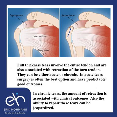 supraspinatus tear tests|full thickness tear supraspinatus.